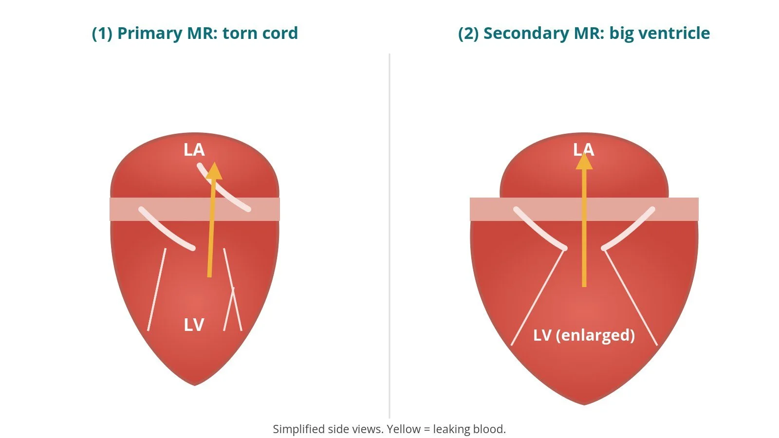 Diagram comparing primary and secondary mitral regurgitation