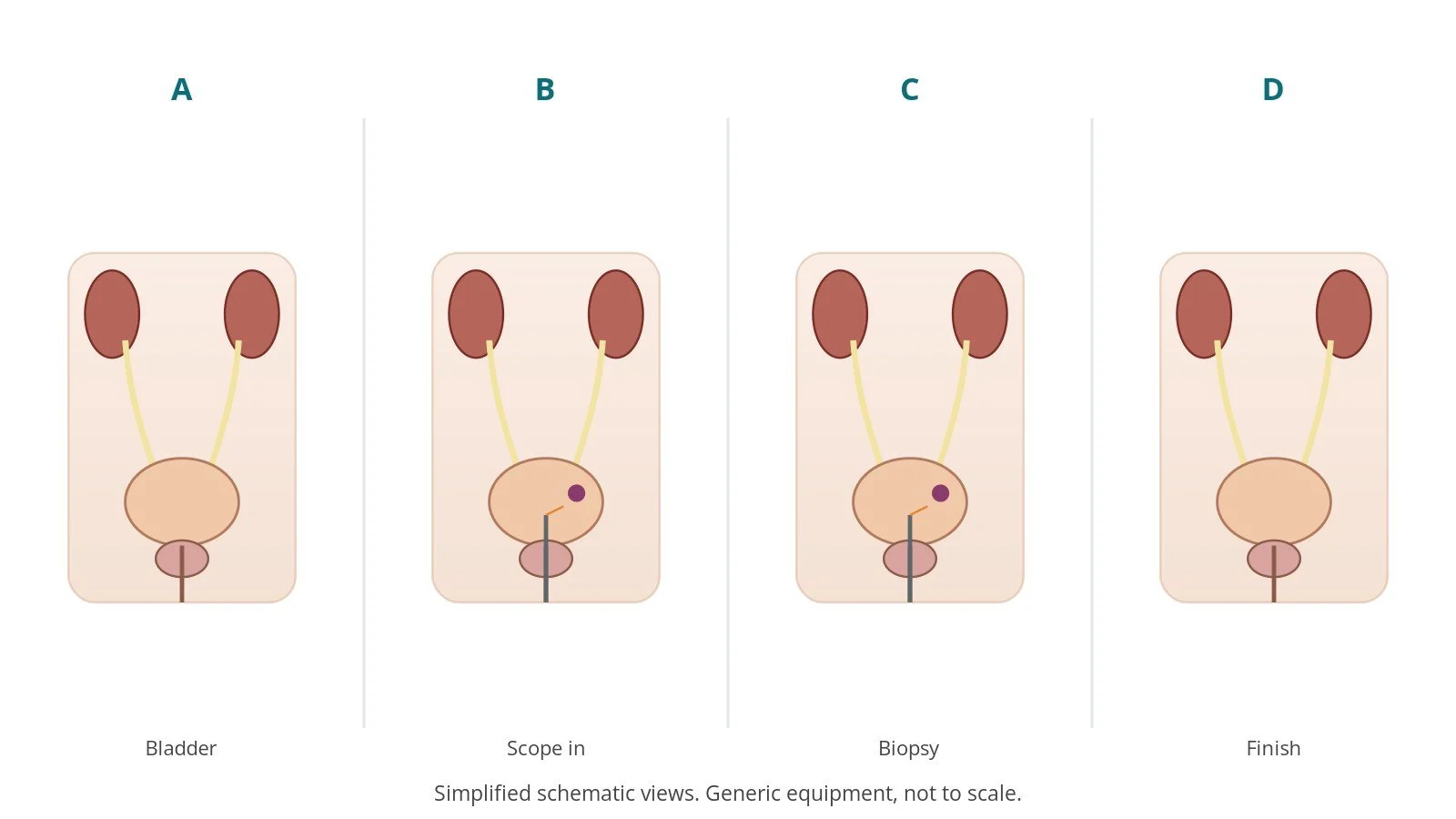 Four-panel schematic of cystoscopy: bladder, scope in, biopsy, finish