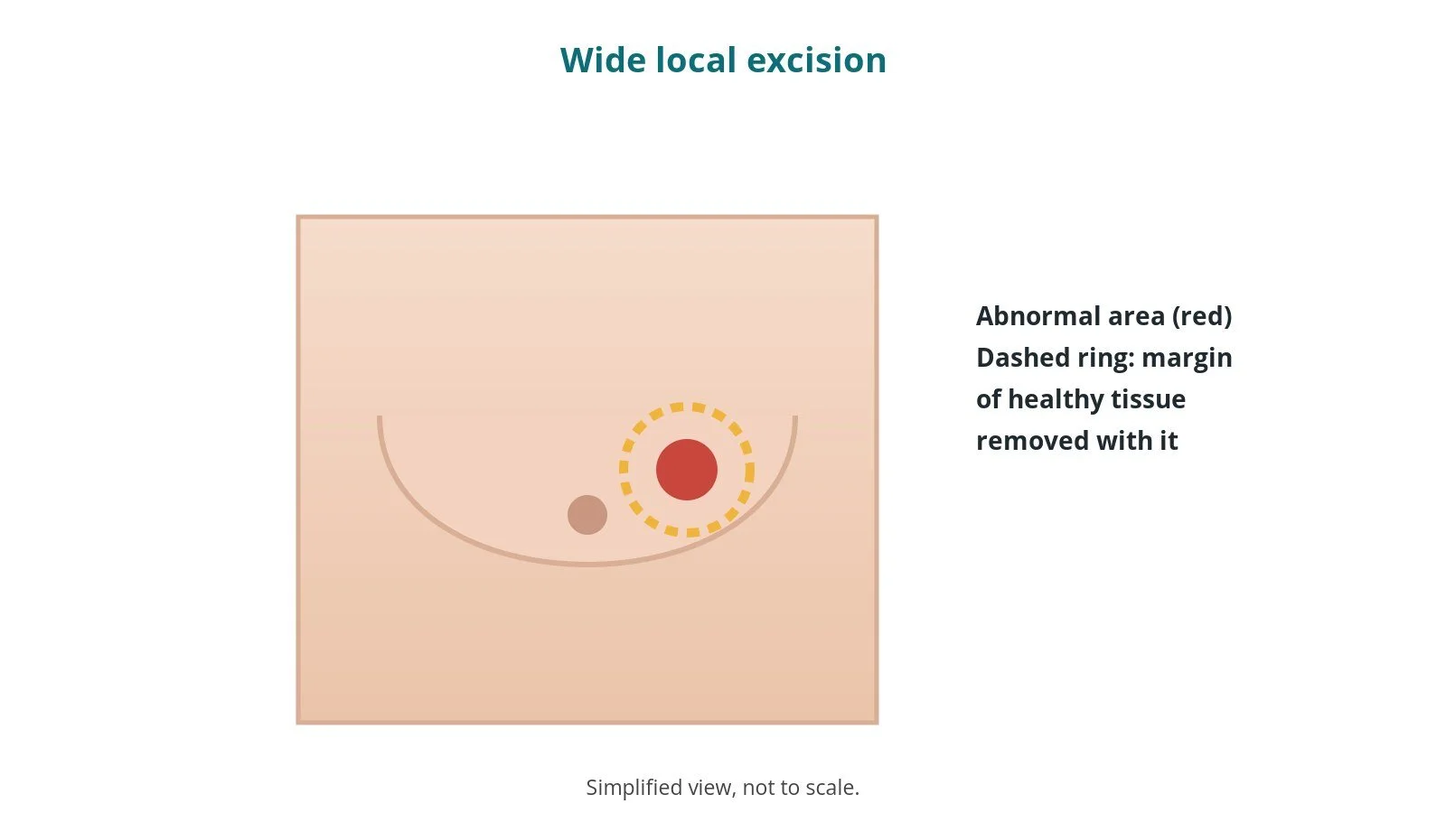 Diagram of a breast with an abnormal area shown in red and a dashed ring around it marking the margin of healthy tissue