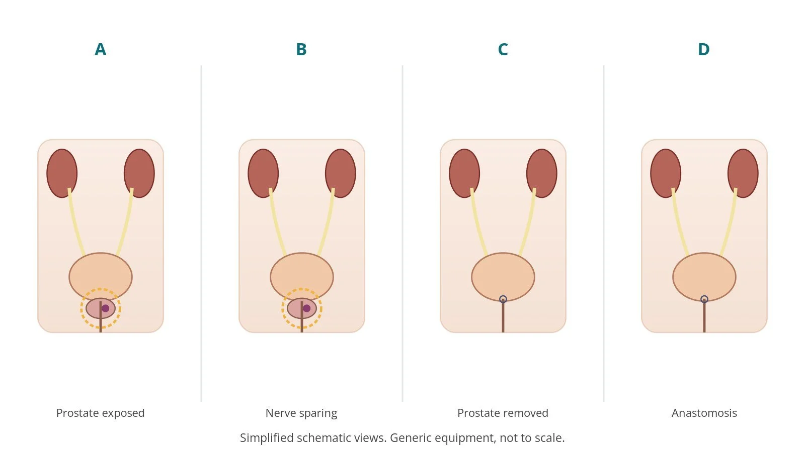 Four-panel schematic of radical prostatectomy: prostate exposed, nerve sparing, prostate removed, anastomosis
