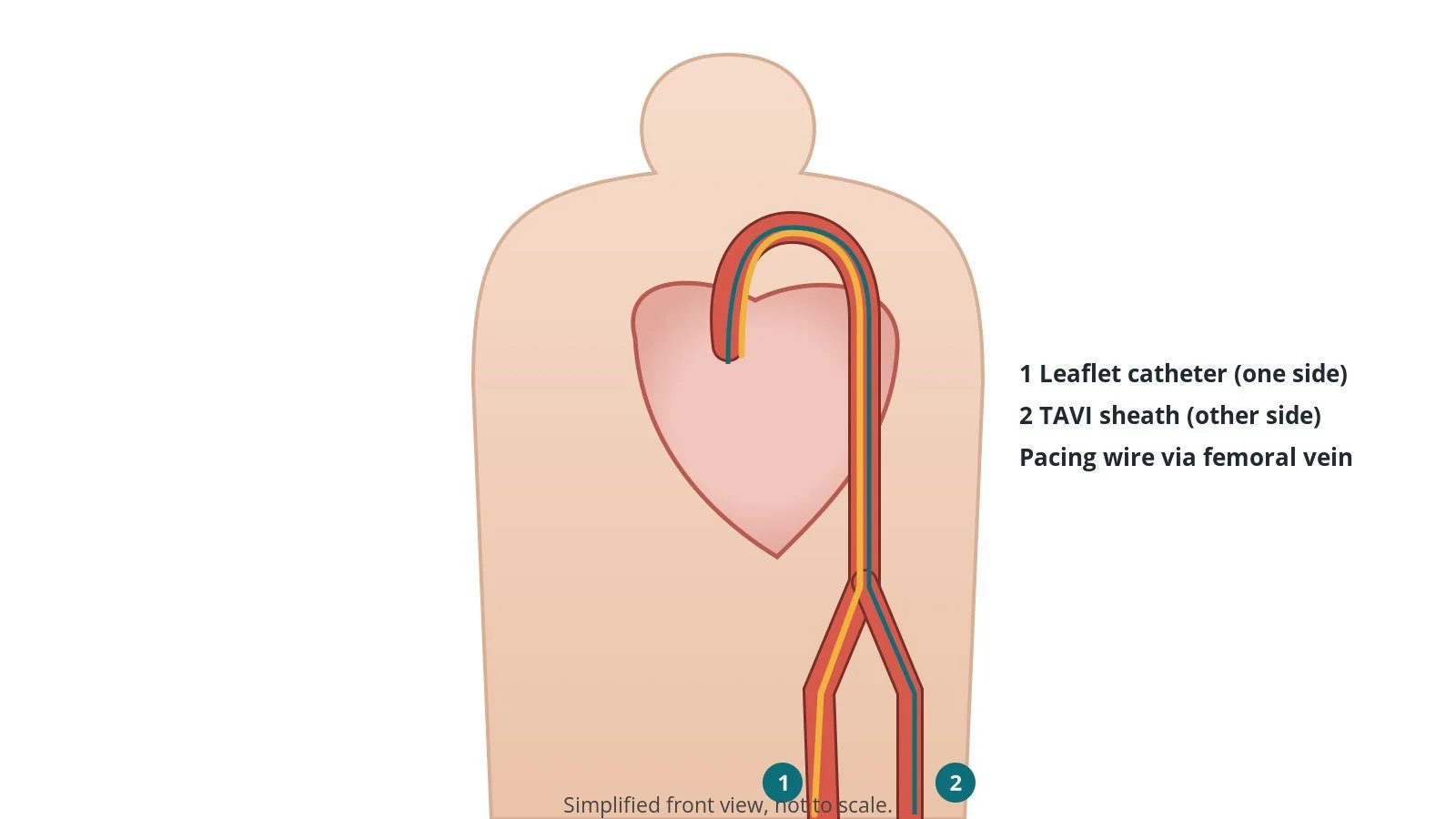 Front view of a patient showing sheaths in both femoral arteries with catheters up the aorta to the aortic valve, and a femoral vein pacing wire