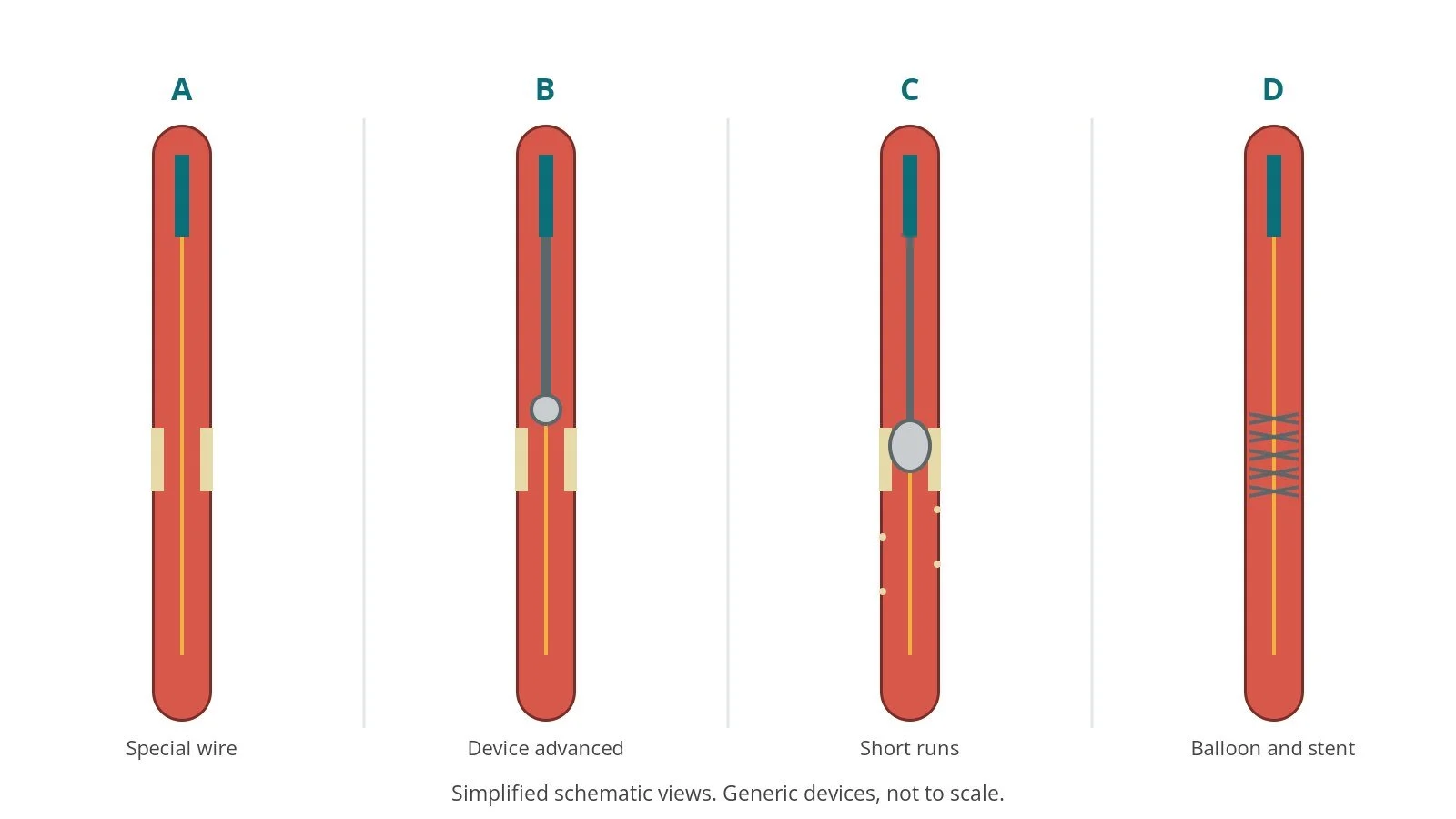 Four-panel schematic of coronary atherectomy: special wire, device advanced, short runs, balloon and stent