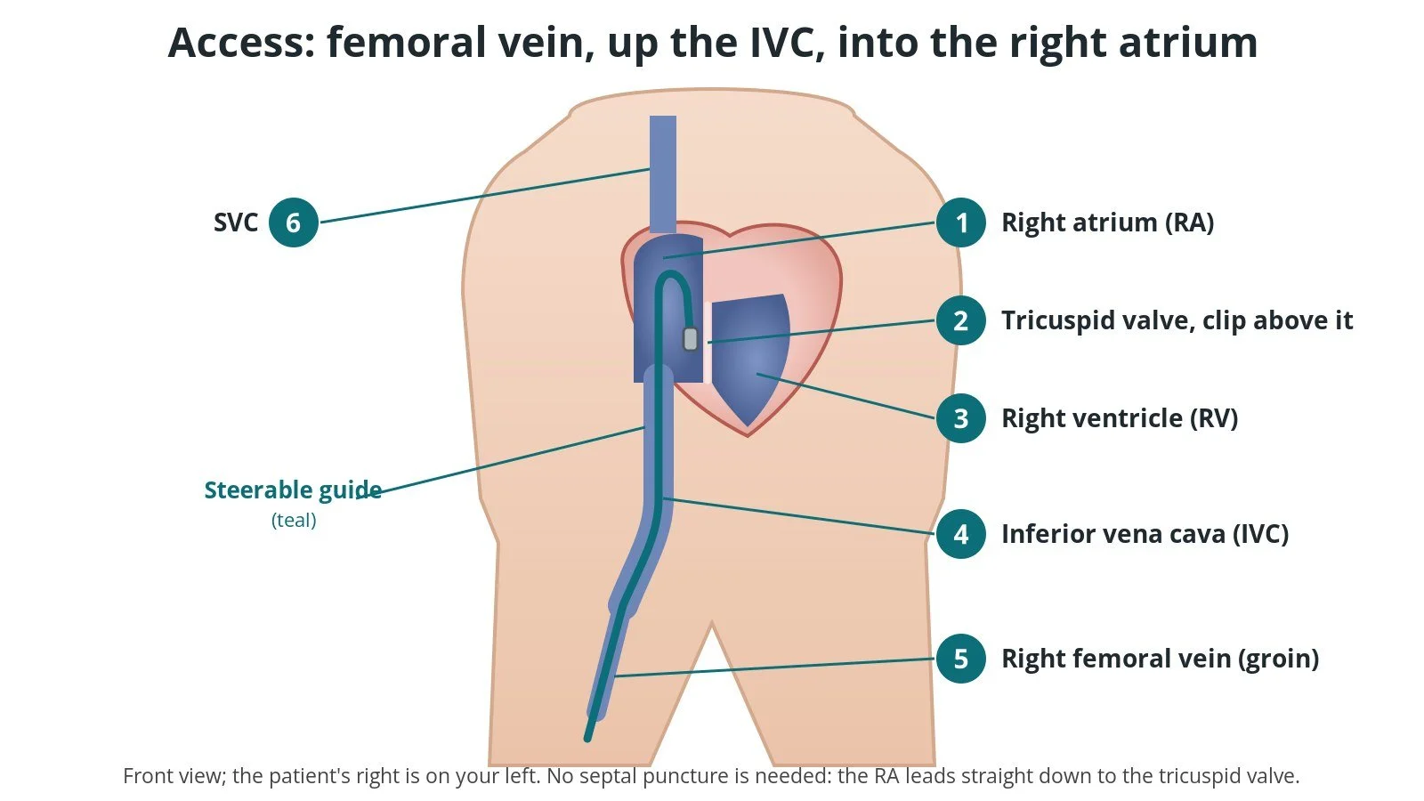 Diagram of access for tricuspid TEER through the femoral vein and inferior vena cava to the right atrium
