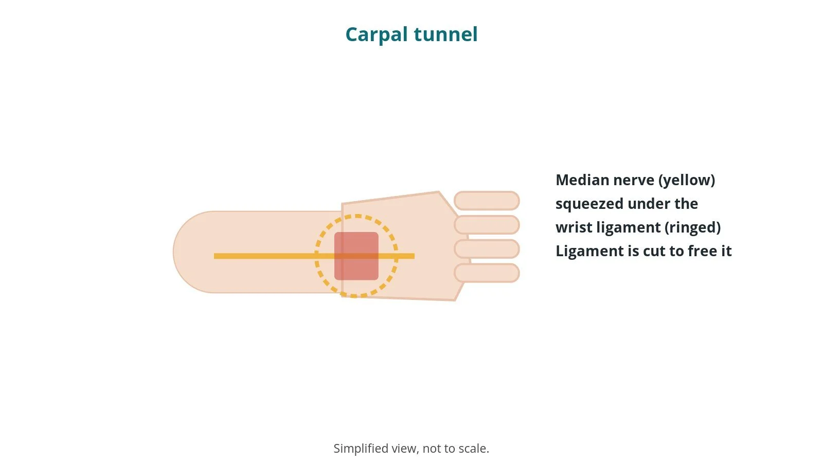 Diagram of the forearm and hand with the median nerve running under a tight ligament at the wrist, ringed