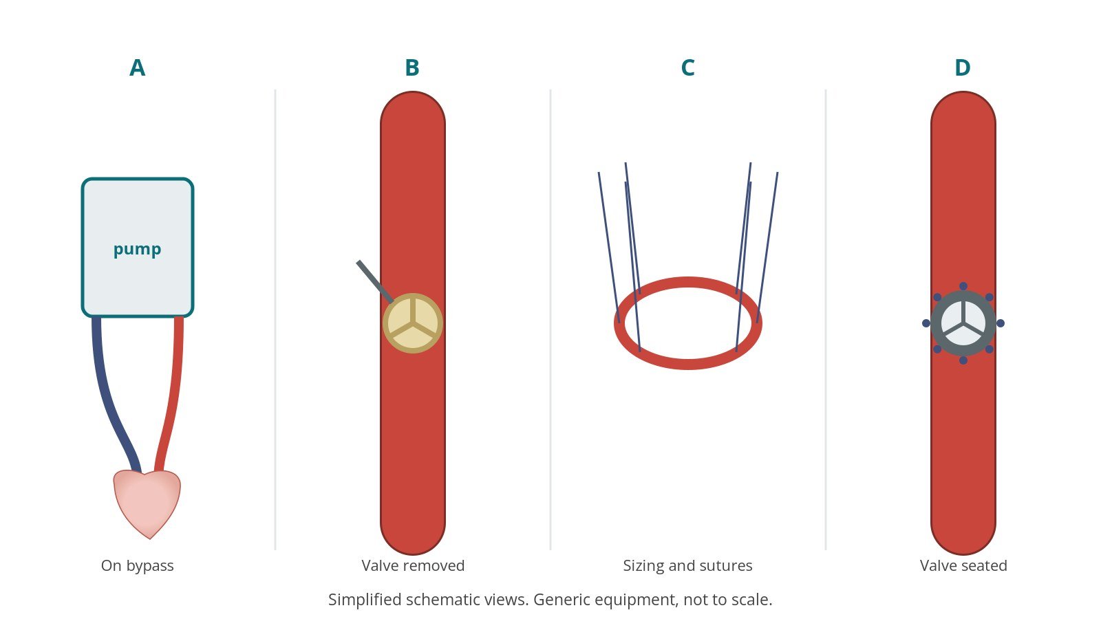 Four-panel schematic of surgical AVR: on bypass, valve removed, sizing and sutures, valve seated