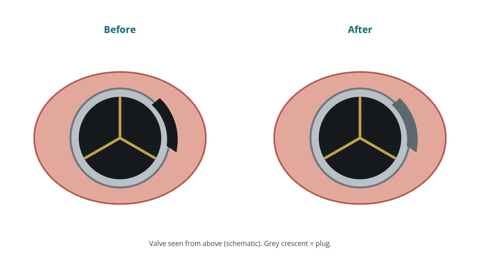 Valve seen from above before and after closure: a crescent-shaped gap beside the valve ring, then filled with a plug