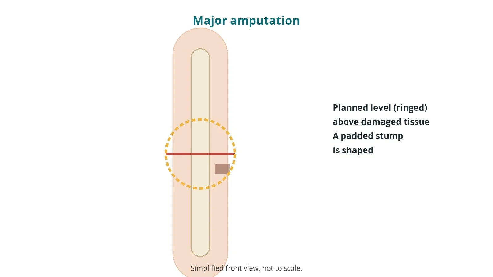 Diagram of a leg with a red line marking the amputation level below the knee above an area of damaged tissue, ringed