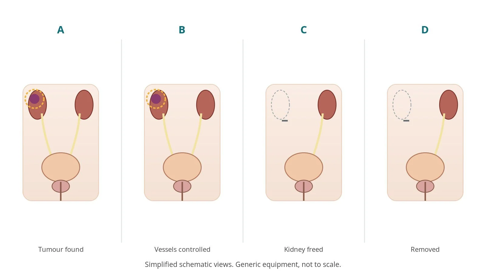 Four-panel schematic of nephrectomy: tumour found, vessels controlled, kidney freed, removed