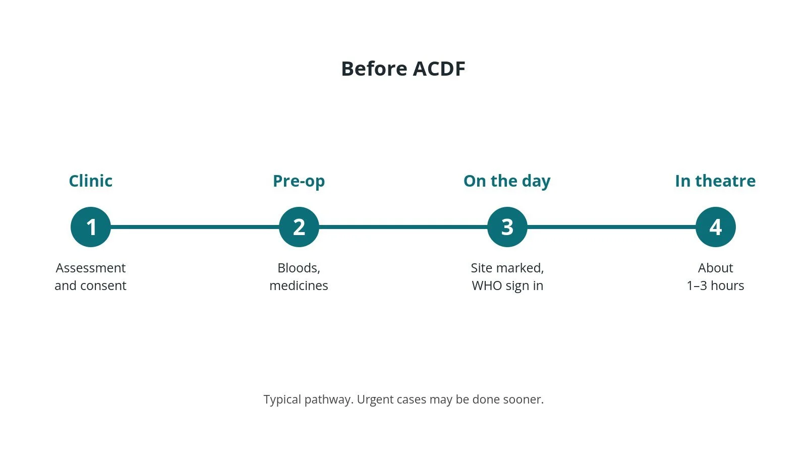 Timeline of the usual steps before ACDF: Clinic: Assessment and consent, Pre-op: Bloods, medicines, On the day: Site marked, WHO sign in, In theatre: About 1–3 hours