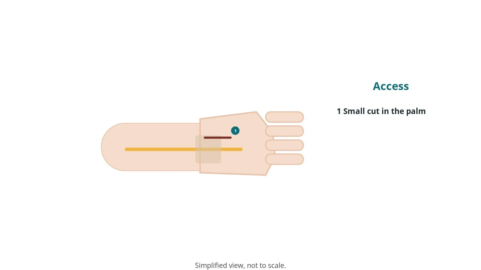Diagram of the forearm and hand showing a small incision in the palm over the carpal tunnel