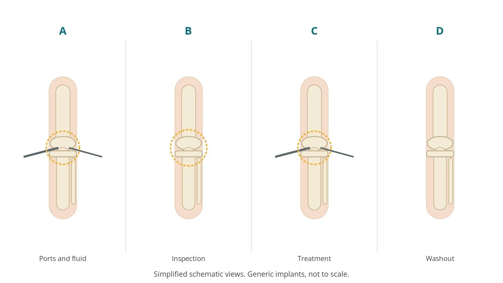 Four-panel schematic of knee arthroscopy: ports and fluid, inspection, treatment, washout