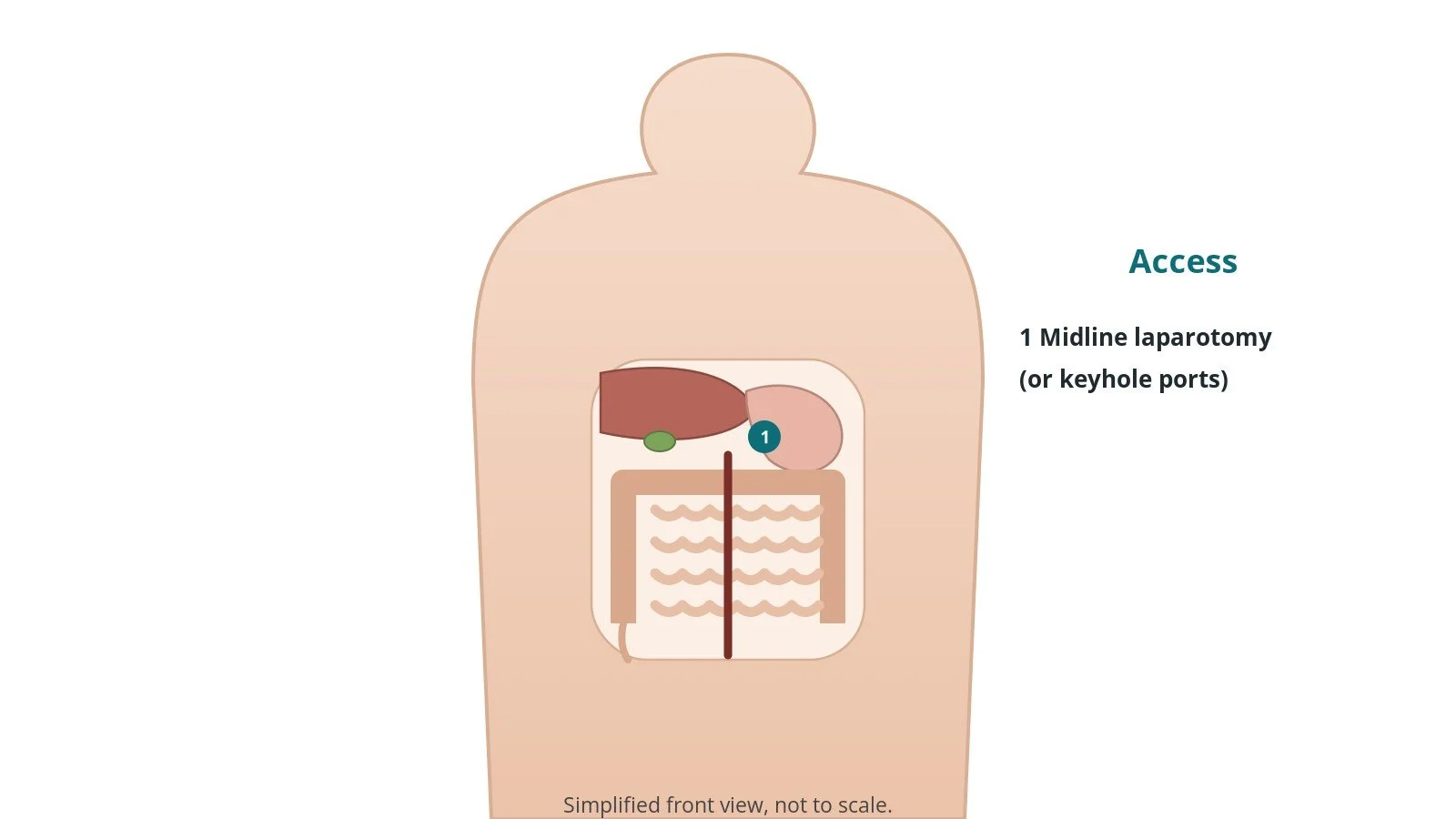 Front view of a patient showing a vertical midline incision down the abdomen