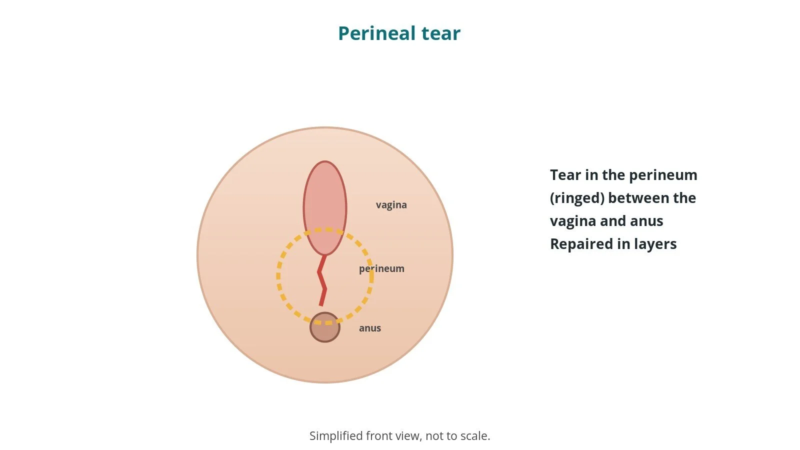 Simplified diagram of the perineum showing a tear between the vagina and anus, ringed