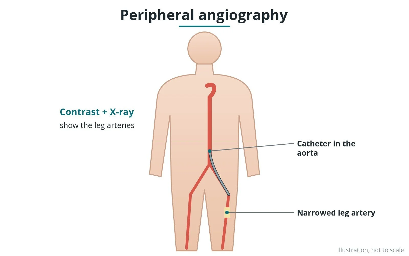 Diagram of contrast dye filling the leg arteries on X-ray