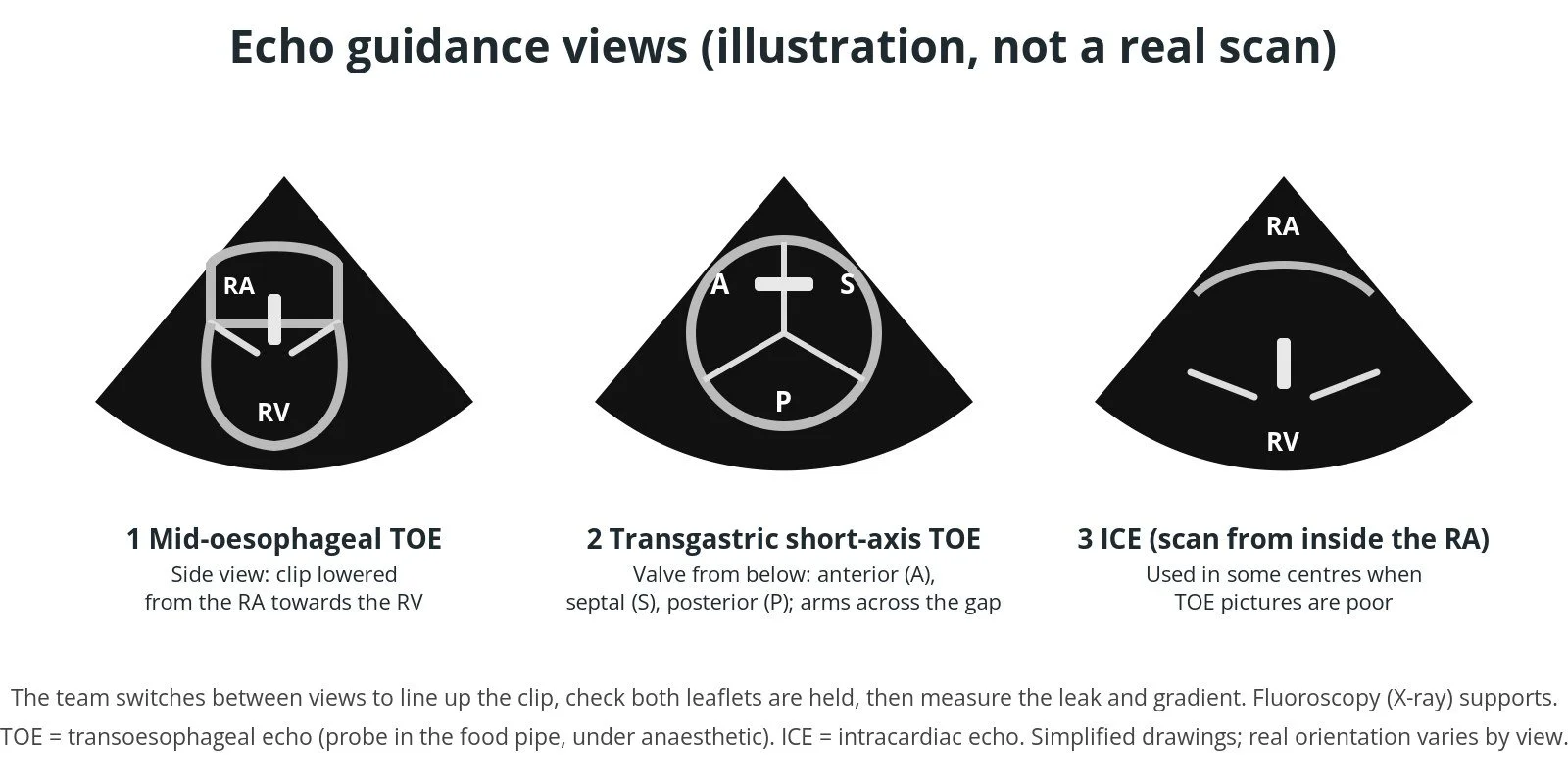 Diagram of echo guidance views used during tricuspid TEER: TOE and intracardiac echo