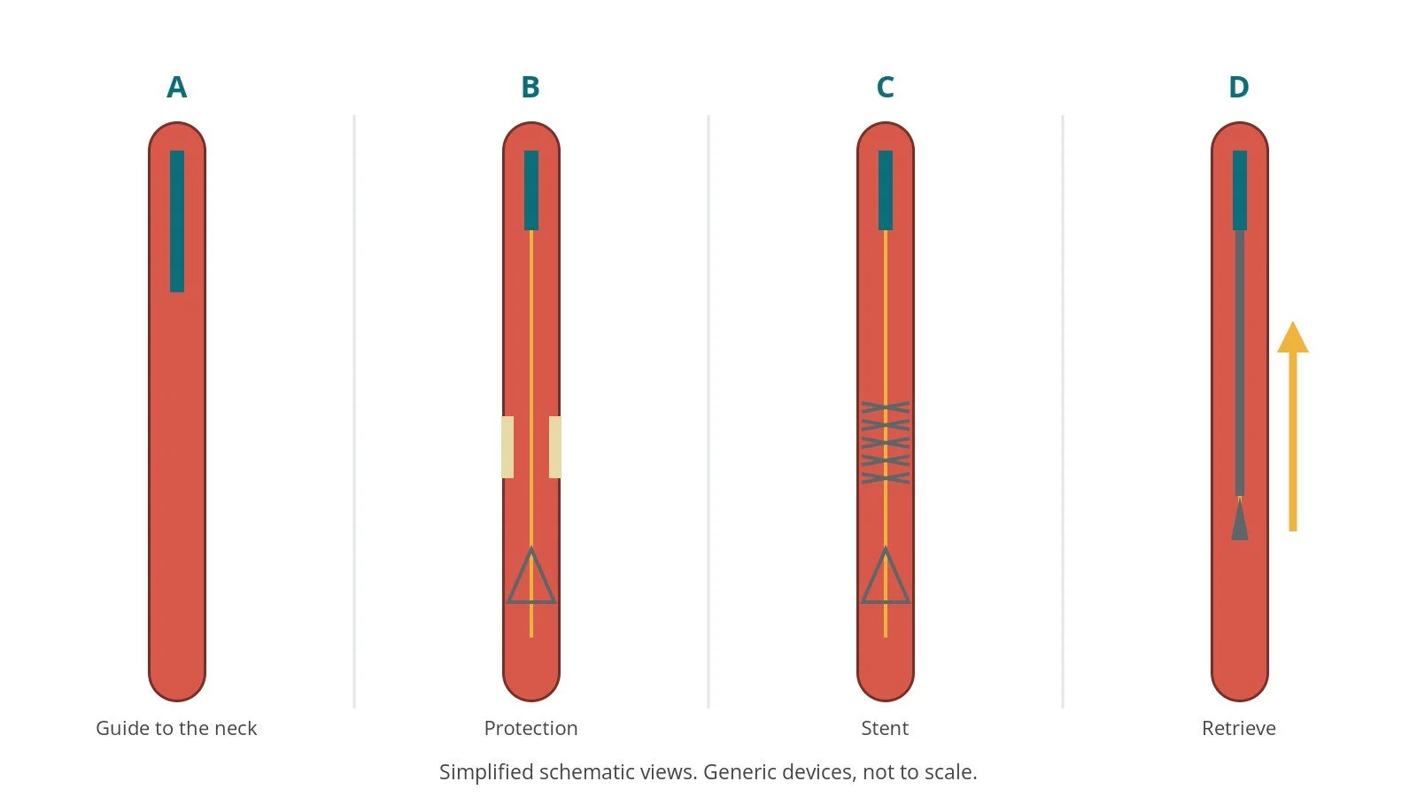 Four-panel schematic of carotid stenting: guide to the neck, protection, stent, retrieve