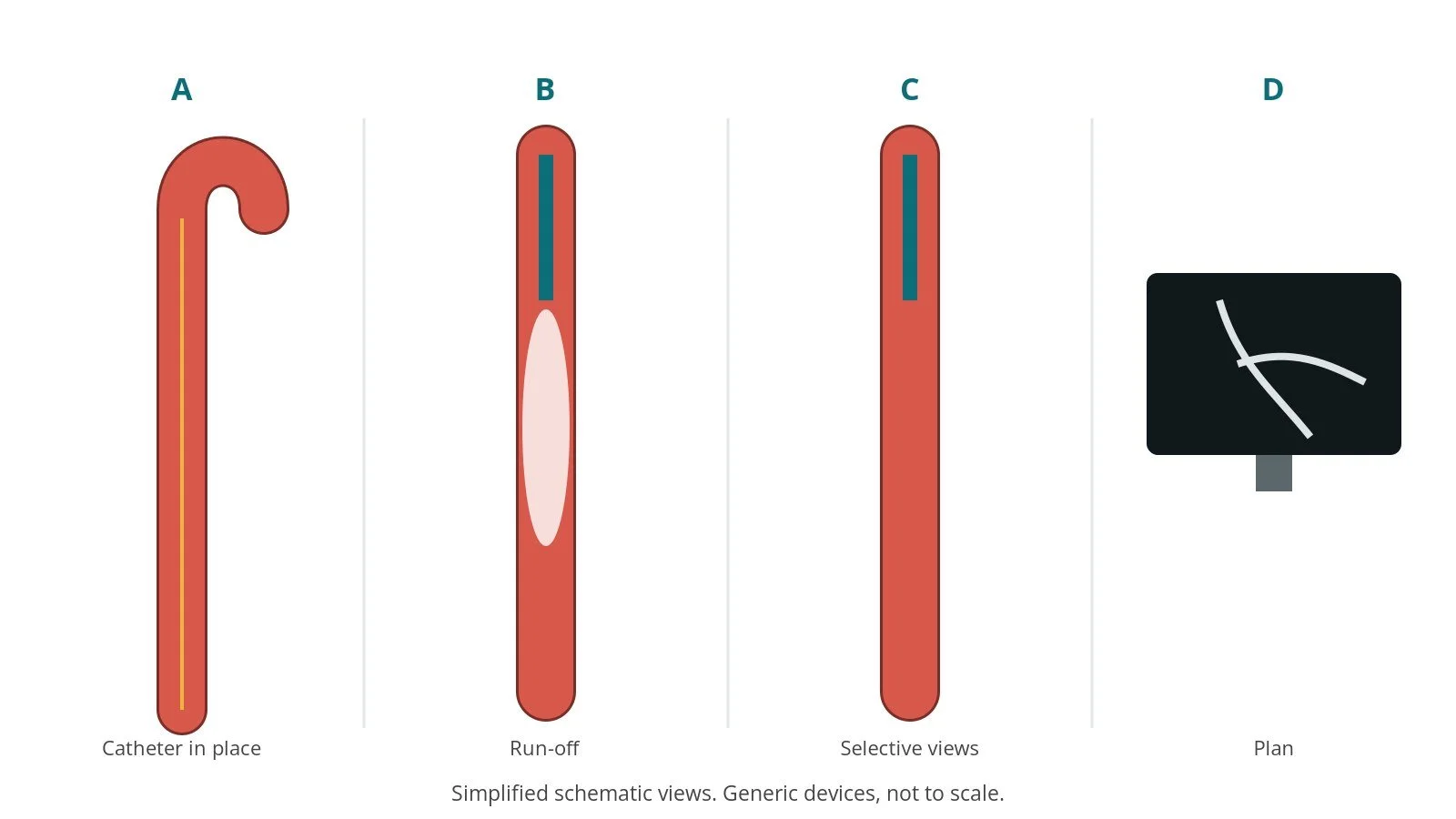 Four-panel schematic of peripheral angiography: catheter in place, run-off, selective views, plan