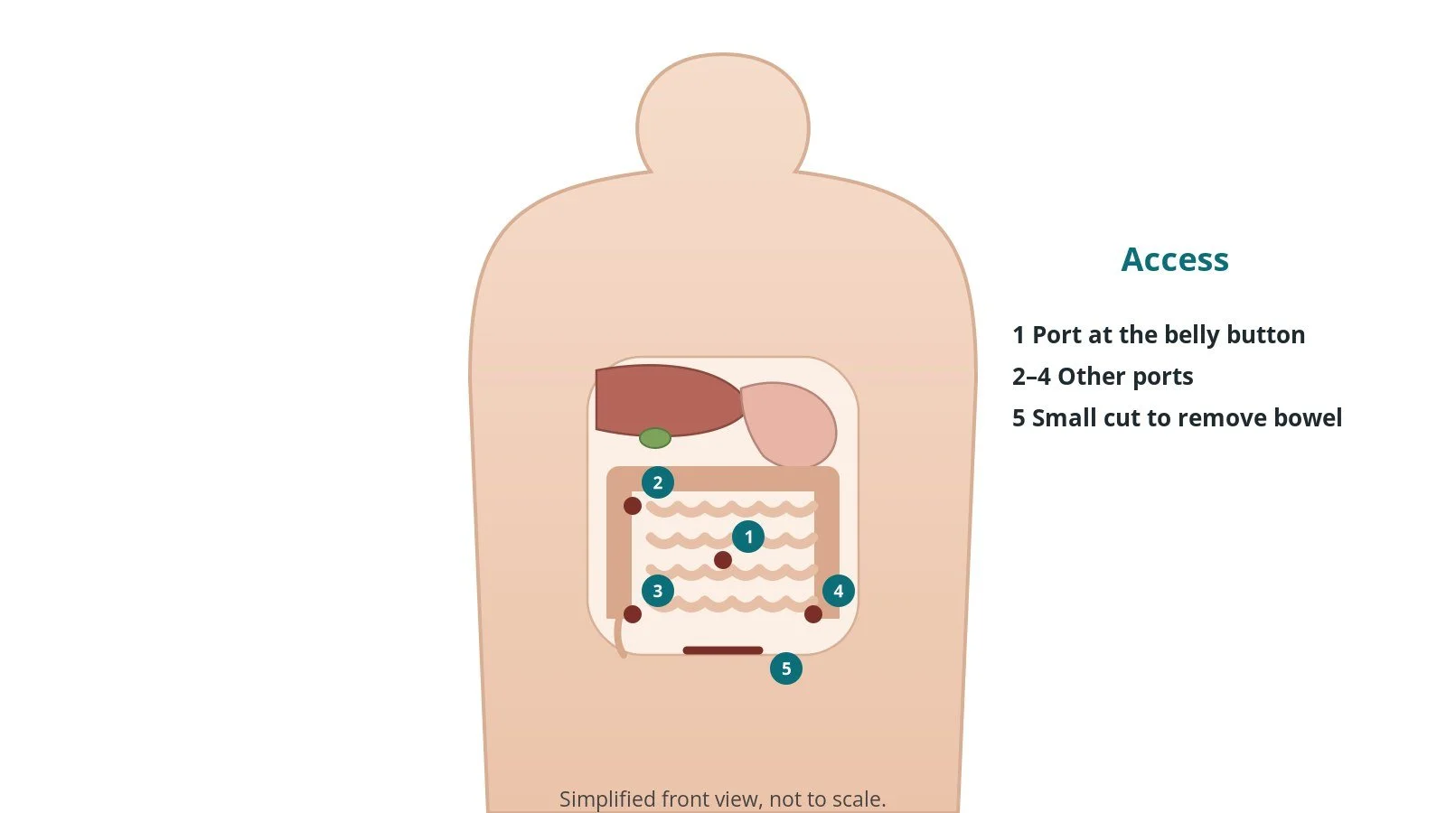 Front view of a patient showing keyhole port sites and a small extraction cut on the abdomen