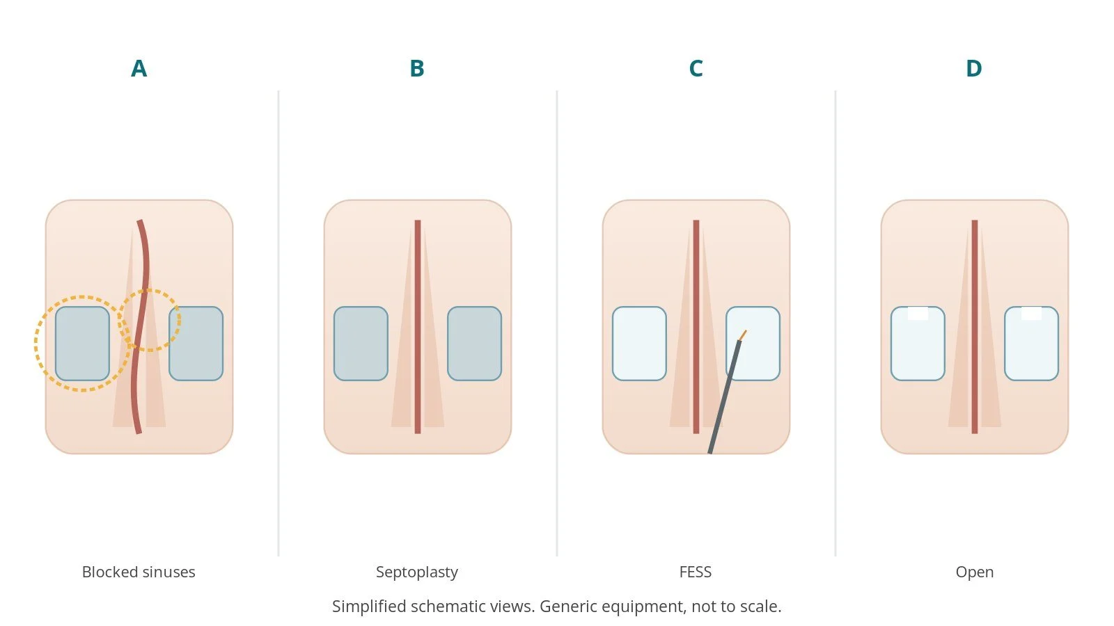 Four-panel schematic of FESS and septoplasty: blocked sinuses, septoplasty, fess, open