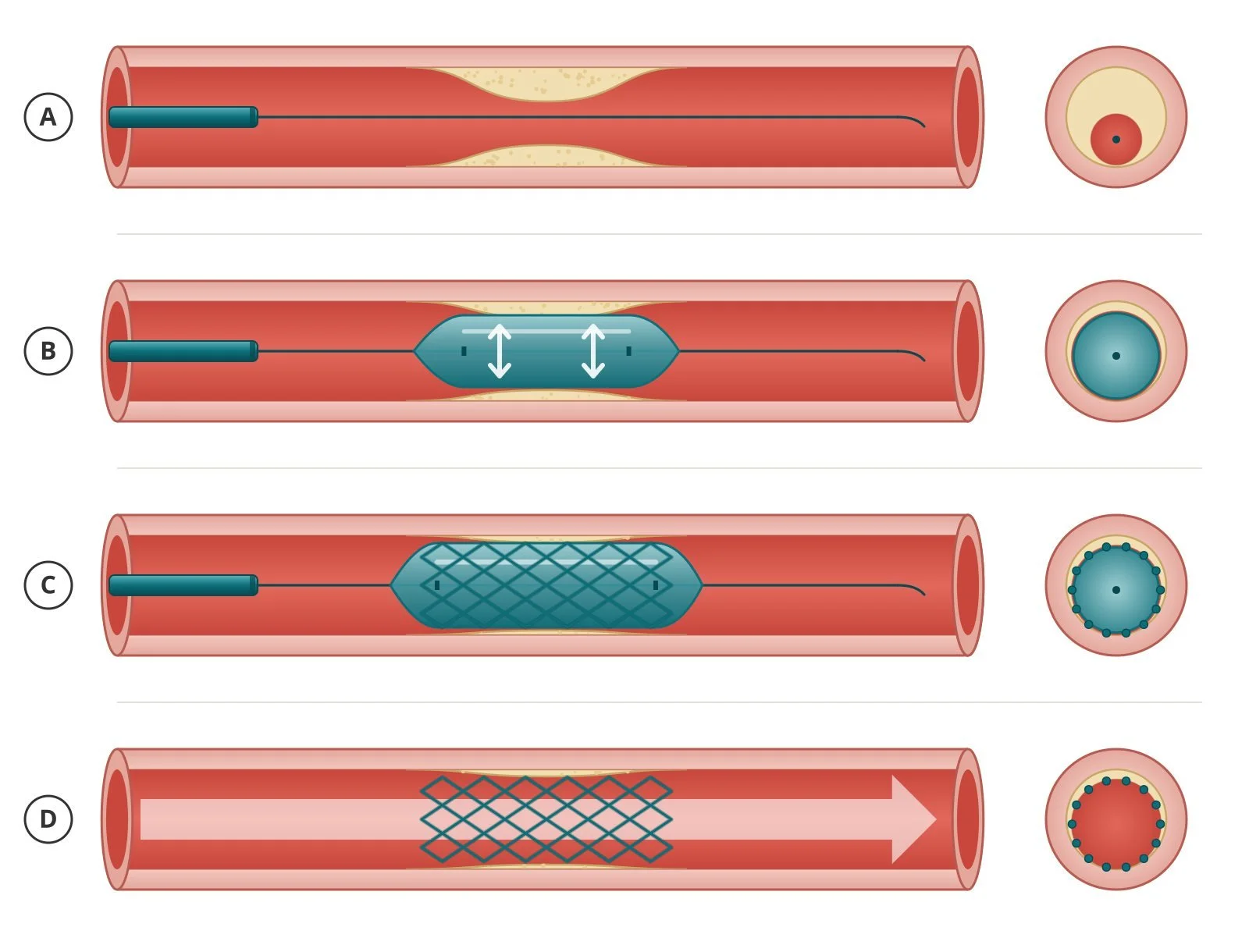 Diagram 4: balloon inflation and stent placement steps