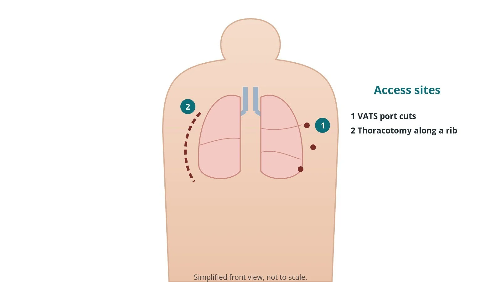 Front view of a patient showing small keyhole port cuts on the side of the chest and the line of a thoracotomy along a rib