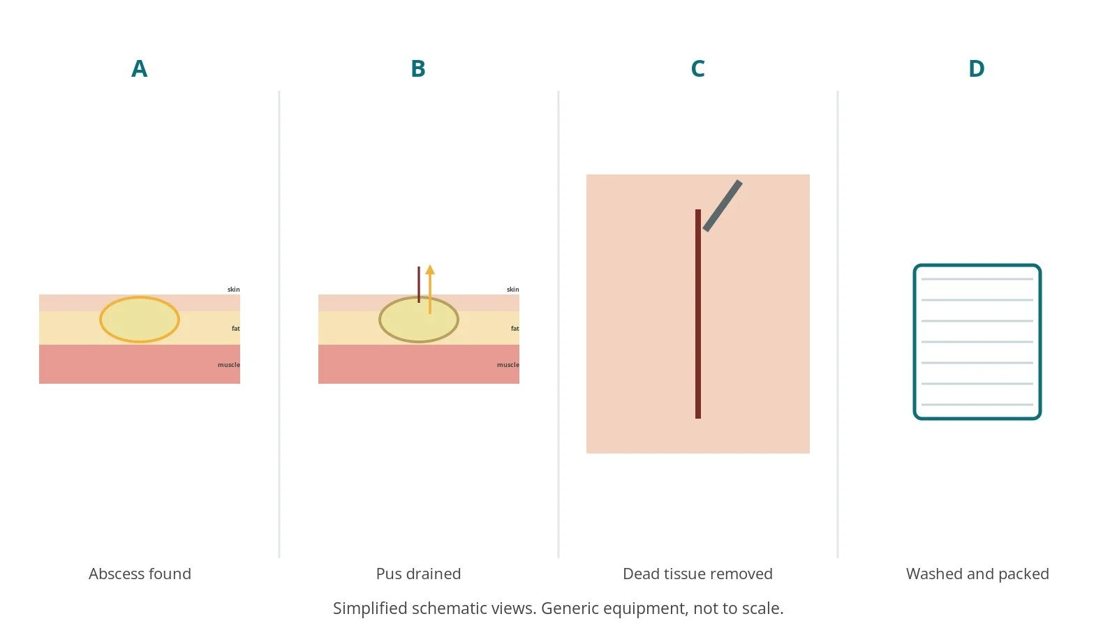 Four-panel schematic of I&D and debridement: abscess found, pus drained, dead tissue removed, washed and packed
