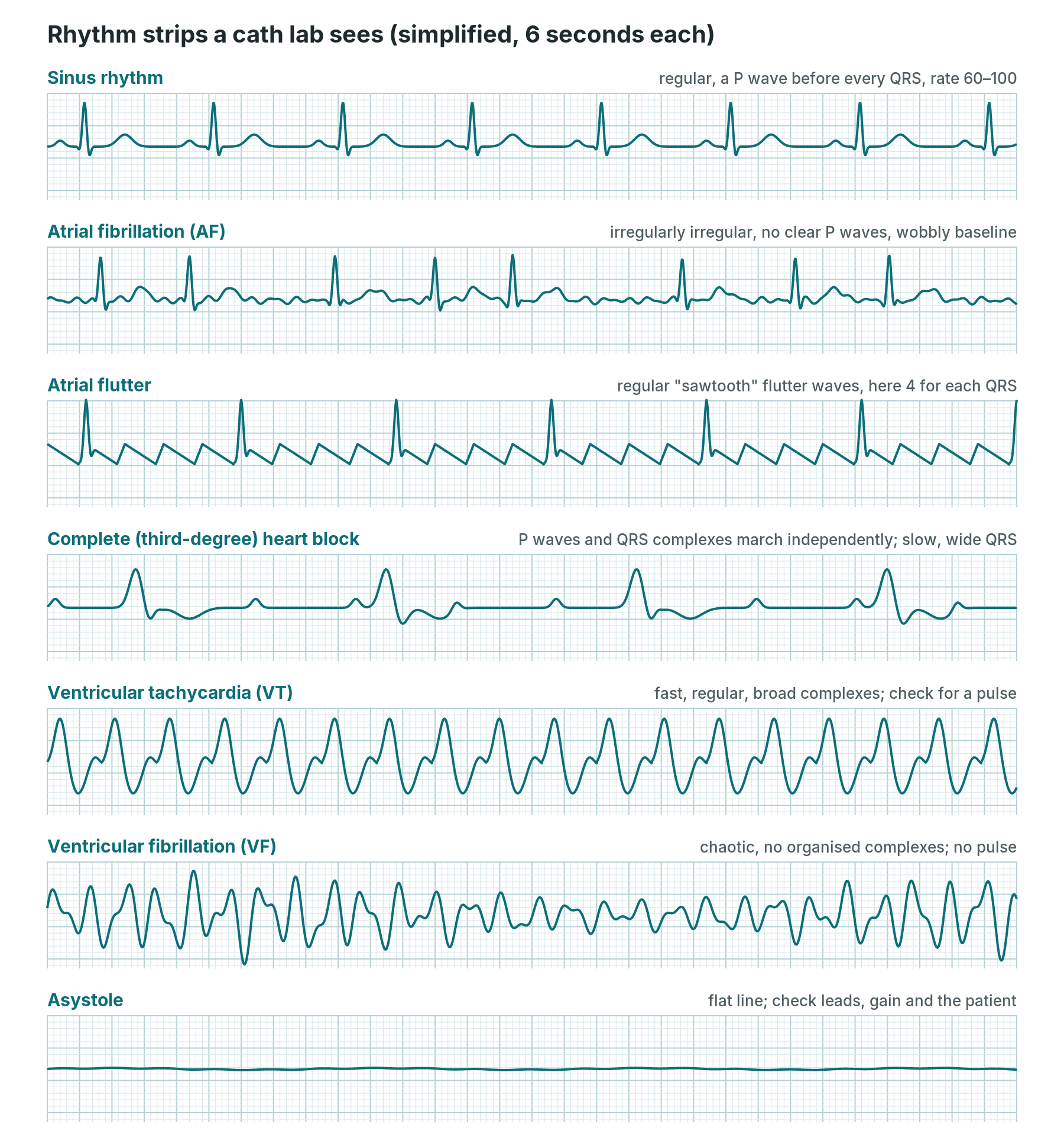Simplified rhythm strips: sinus rhythm, atrial fibrillation, atrial flutter, complete heart block, VT, VF and asystole