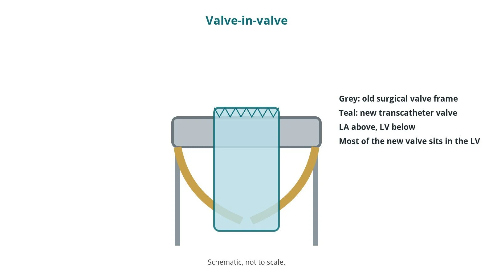 Diagram of a new transcatheter valve expanded inside the frame of an old surgical mitral valve