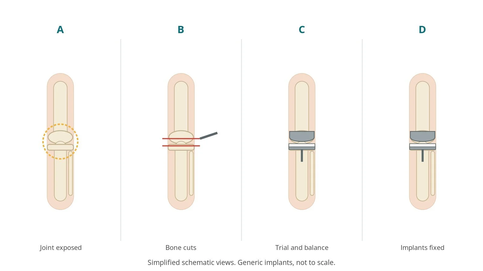Four-panel schematic of knee replacement: joint exposed, bone cuts, trial and balance, implants fixed