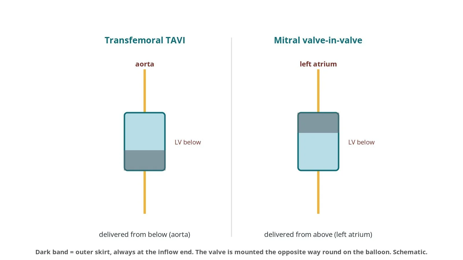 Comparison of balloon-expandable valve orientation for TAVI from the aorta and for mitral valve-in-valve from the left atrium, showing the valve mounted the opposite way round