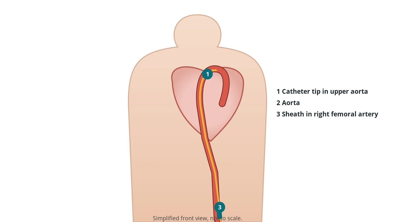 Front view of a patient showing a catheter from the right femoral artery in the groin up the aorta towards the heart