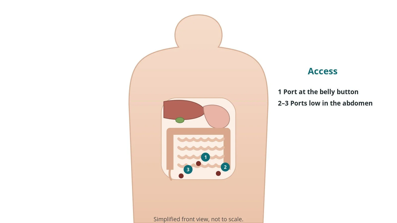Front view of a patient showing a port at the belly button and two low abdominal port sites