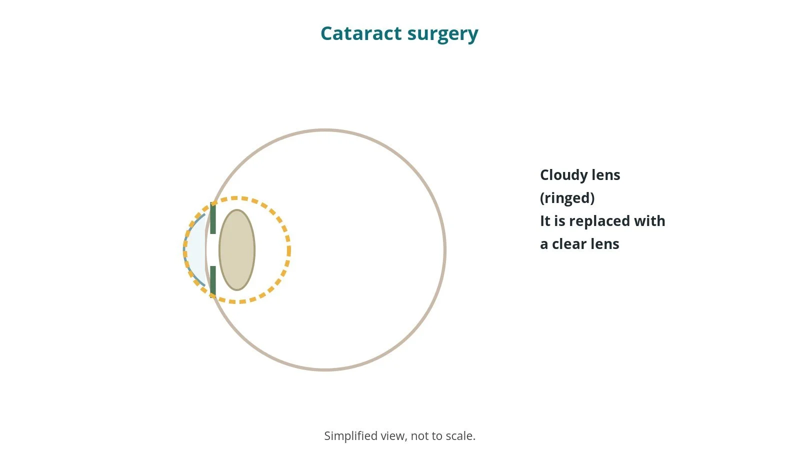 Simplified side-view diagram of the eye with a cloudy lens behind the cornea, ringed
