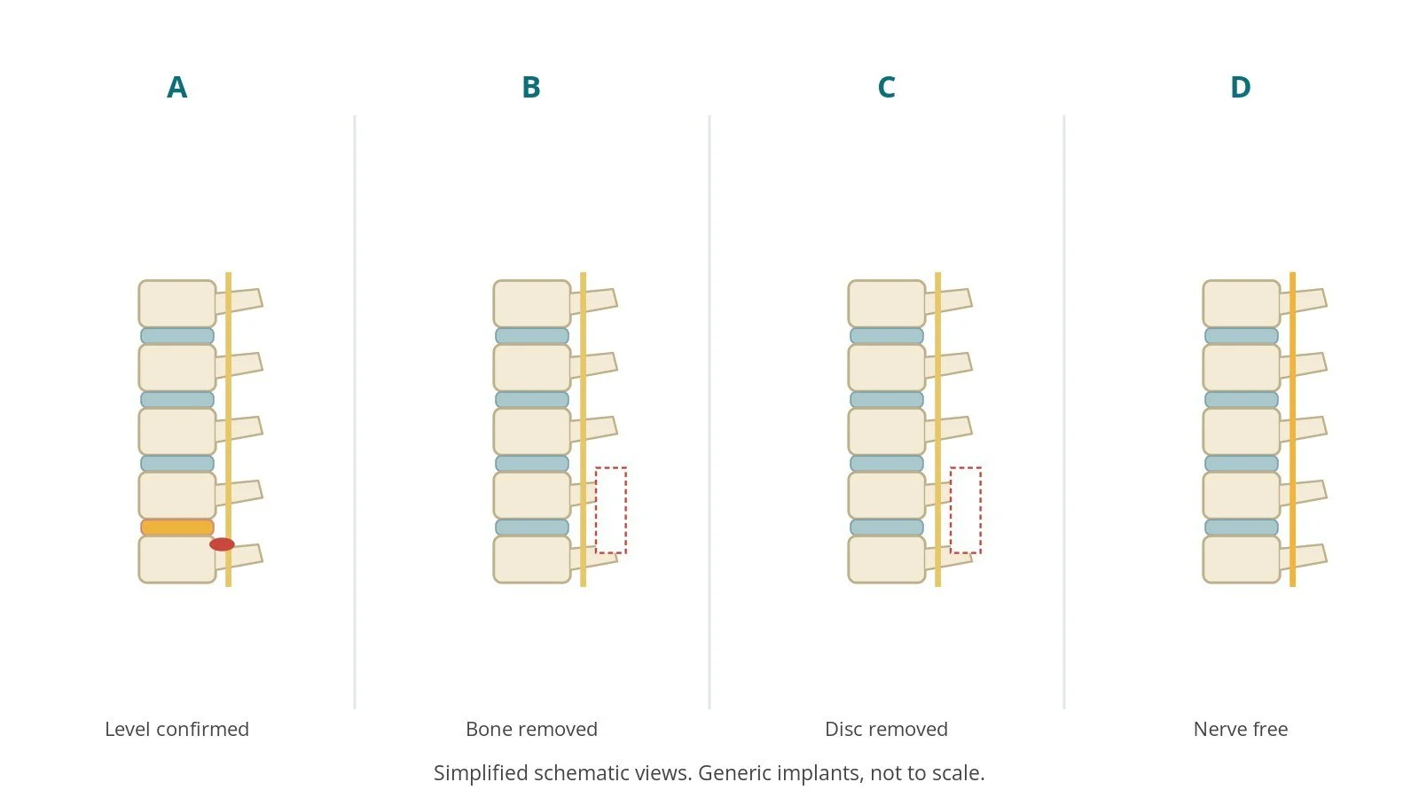 Four-panel schematic of lumbar decompression: level confirmed, bone removed, disc removed, nerve free