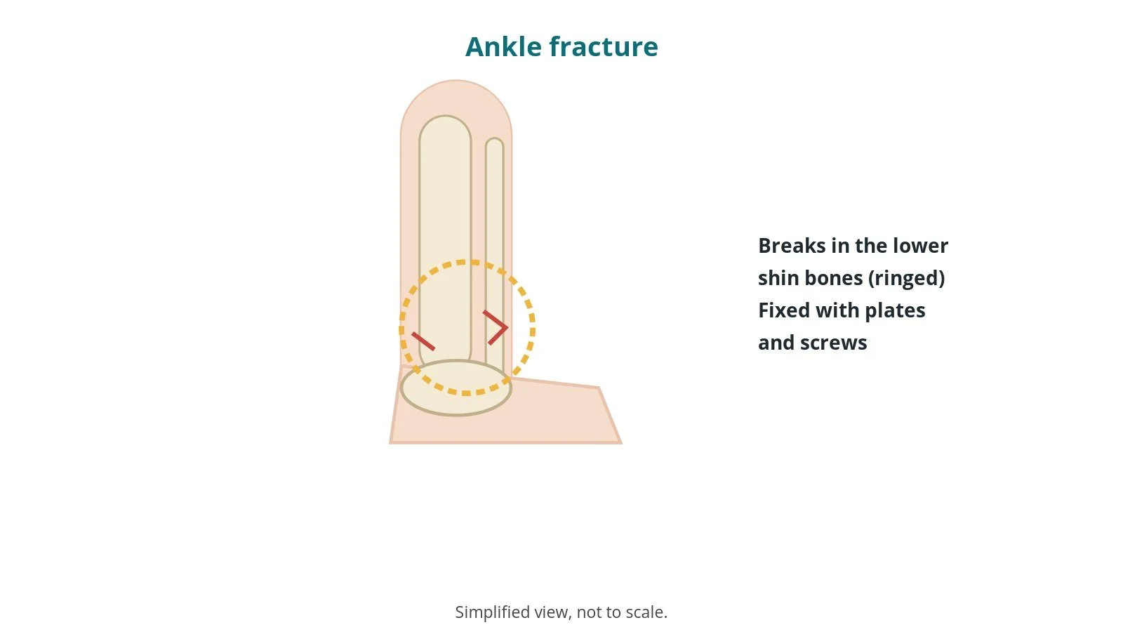 Diagram of the lower leg and ankle showing fracture lines in the lower tibia and fibula, ringed