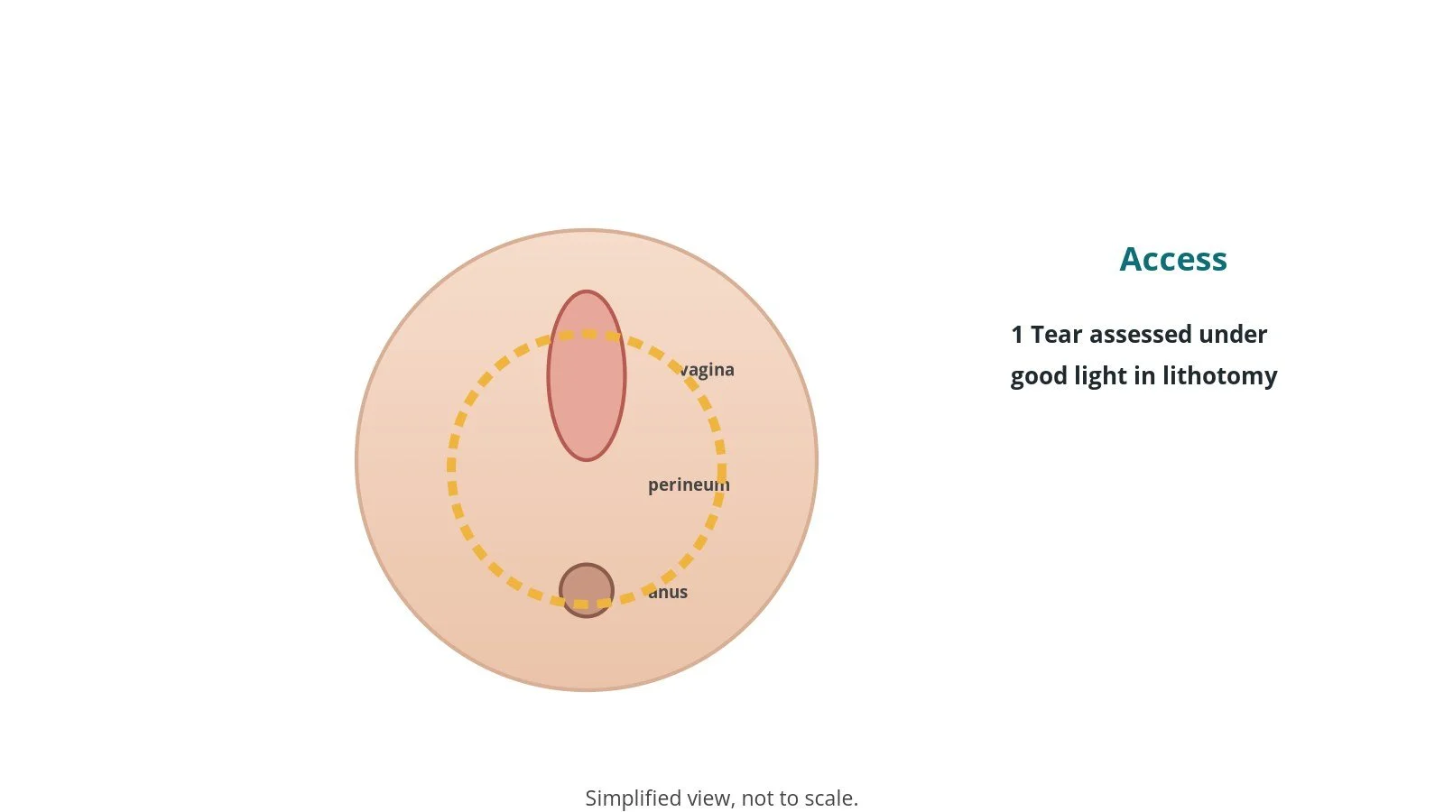 Simplified diagram of the perineum between the vagina and anus with the area of a tear marked