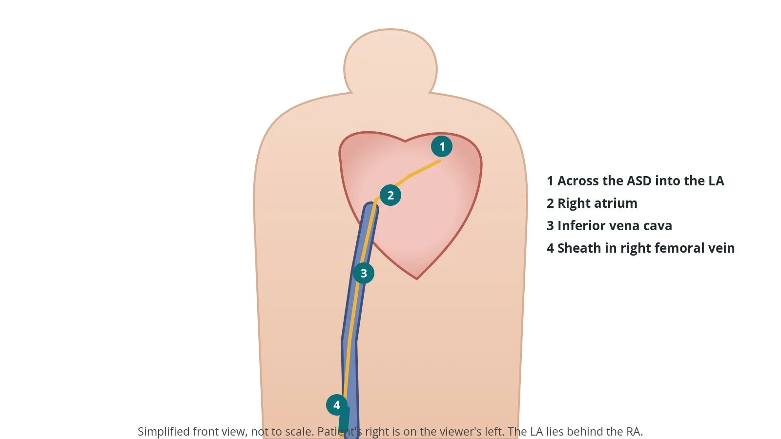 Front view of a patient with a catheter from the right femoral vein up the inferior vena cava into the right atrium and across the ASD into the left atrium