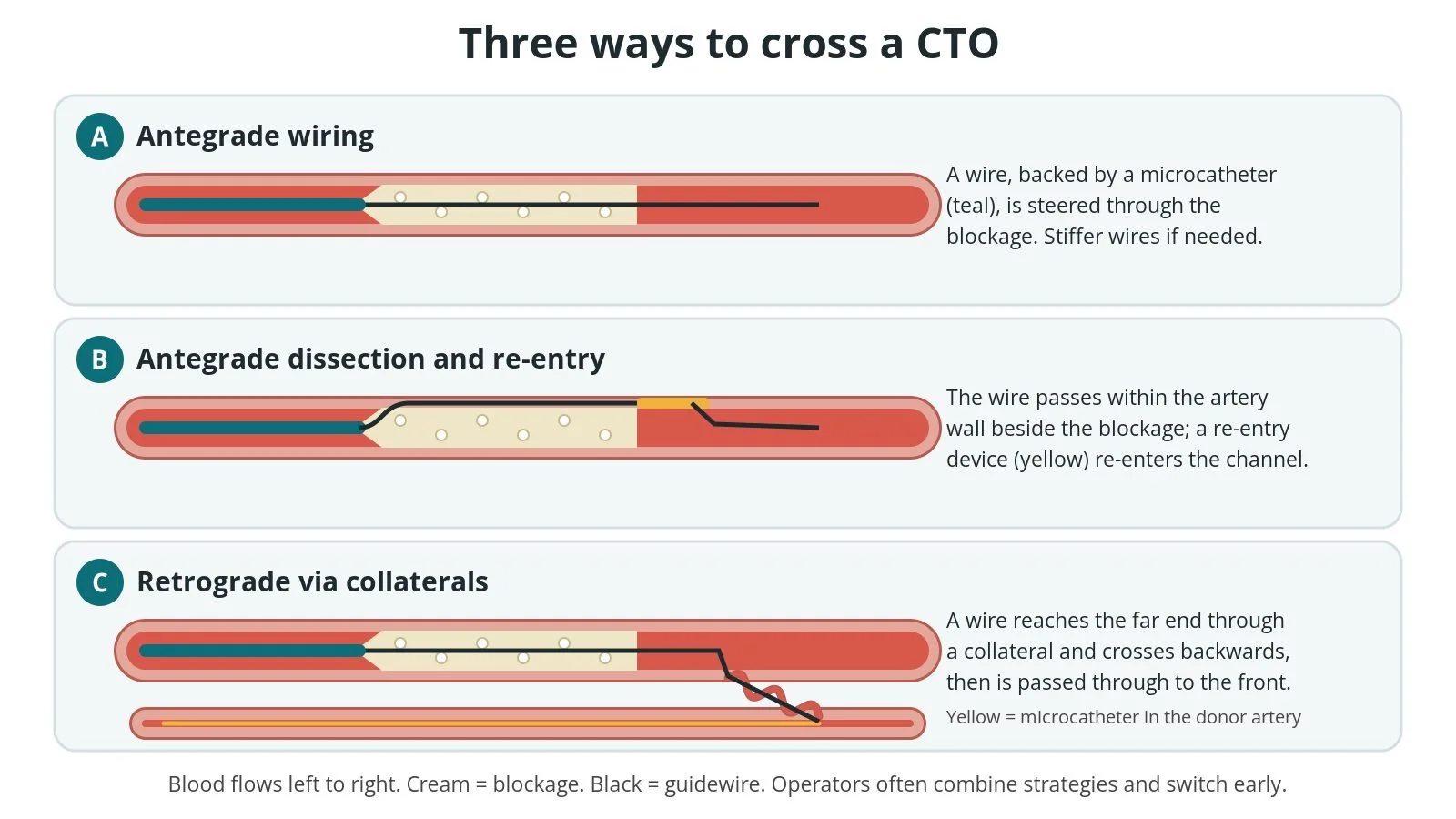 Three panels: A, a wire steered forwards through the blockage; B, a wire passing within the artery wall beside the blockage and re-entering beyond it; C, a wire reaching the far end through a collateral and crossing backwards