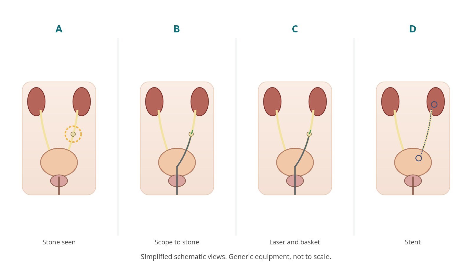 Four-panel schematic of ureteroscopy: stone seen, scope to stone, laser and basket, stent