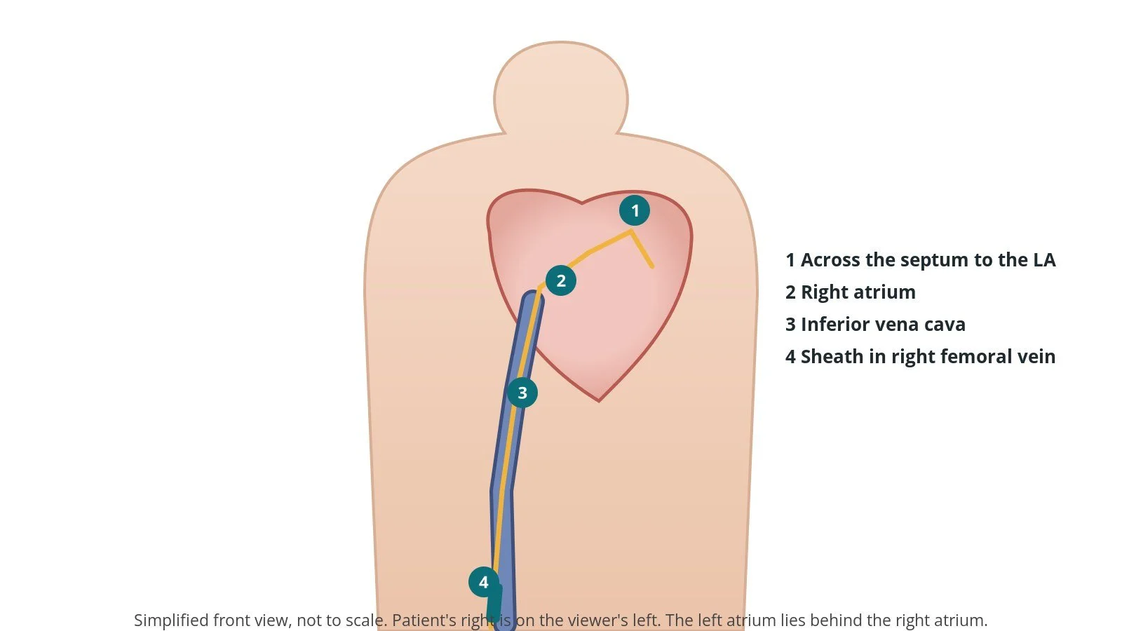 Diagram of access through the femoral vein and across the atrial septum to the mitral valve