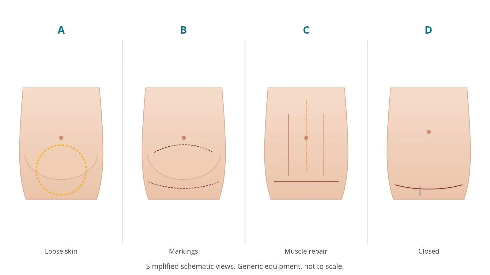 Four-panel schematic of abdominoplasty: loose skin, markings, muscle repair, closed