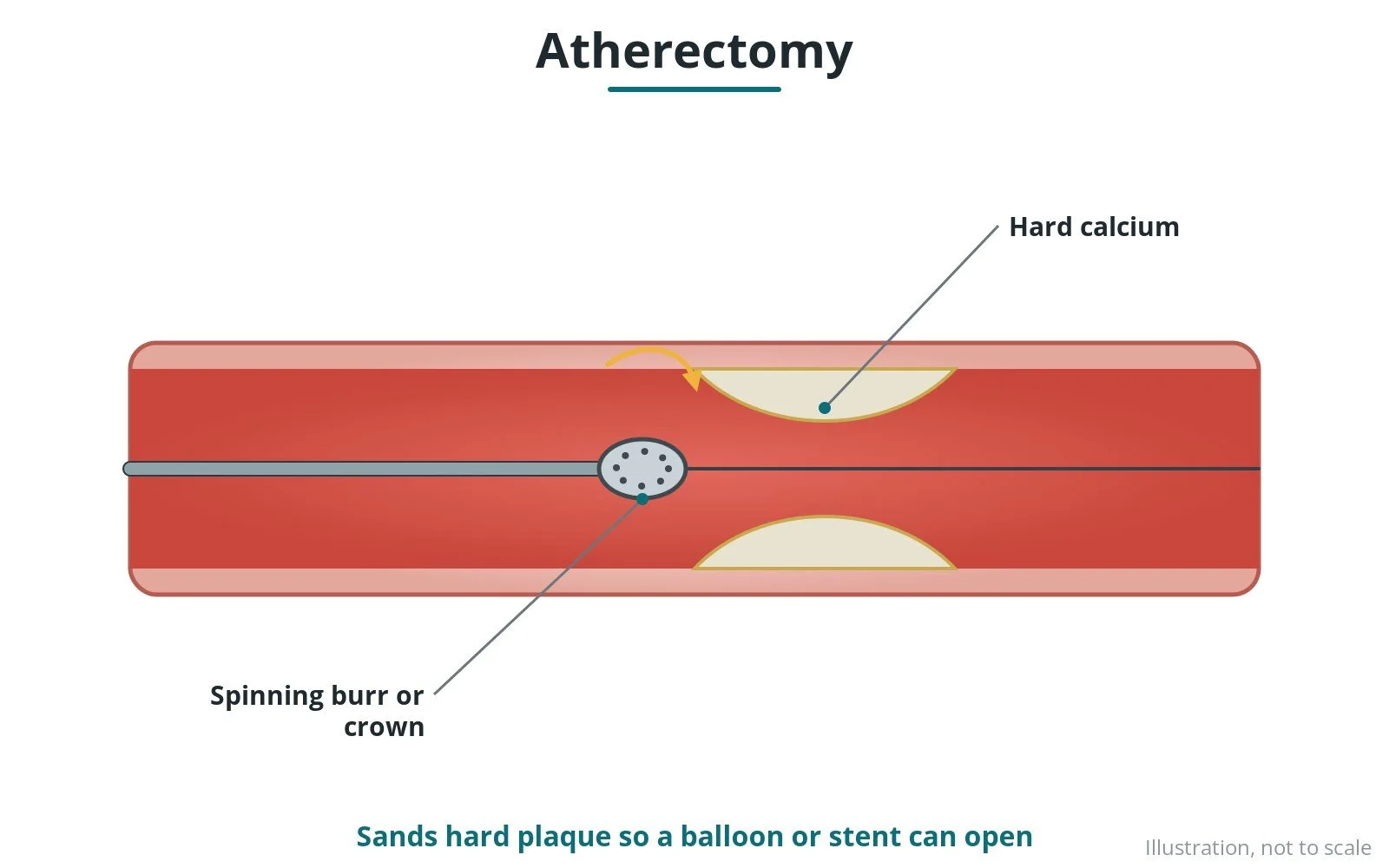 Diagram of a spinning burr sanding calcified plaque inside a heart artery