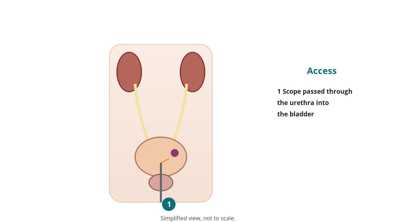 Diagram of the bladder with a cystoscope passed through the urethra