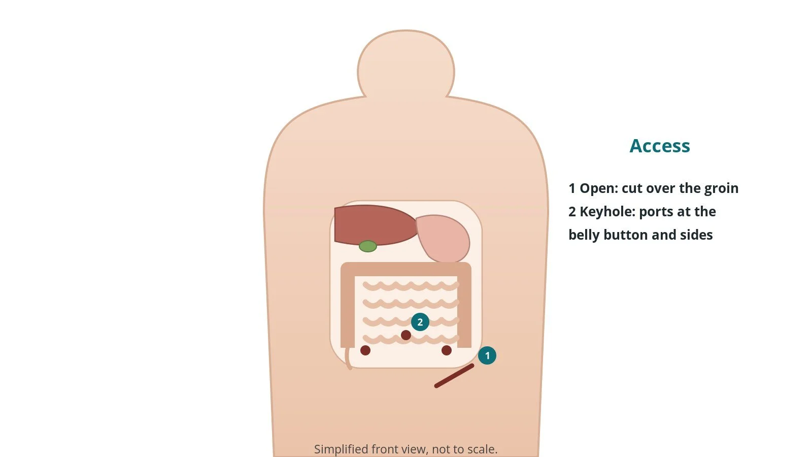 Front view of a patient showing the line of an open groin incision and three keyhole port sites