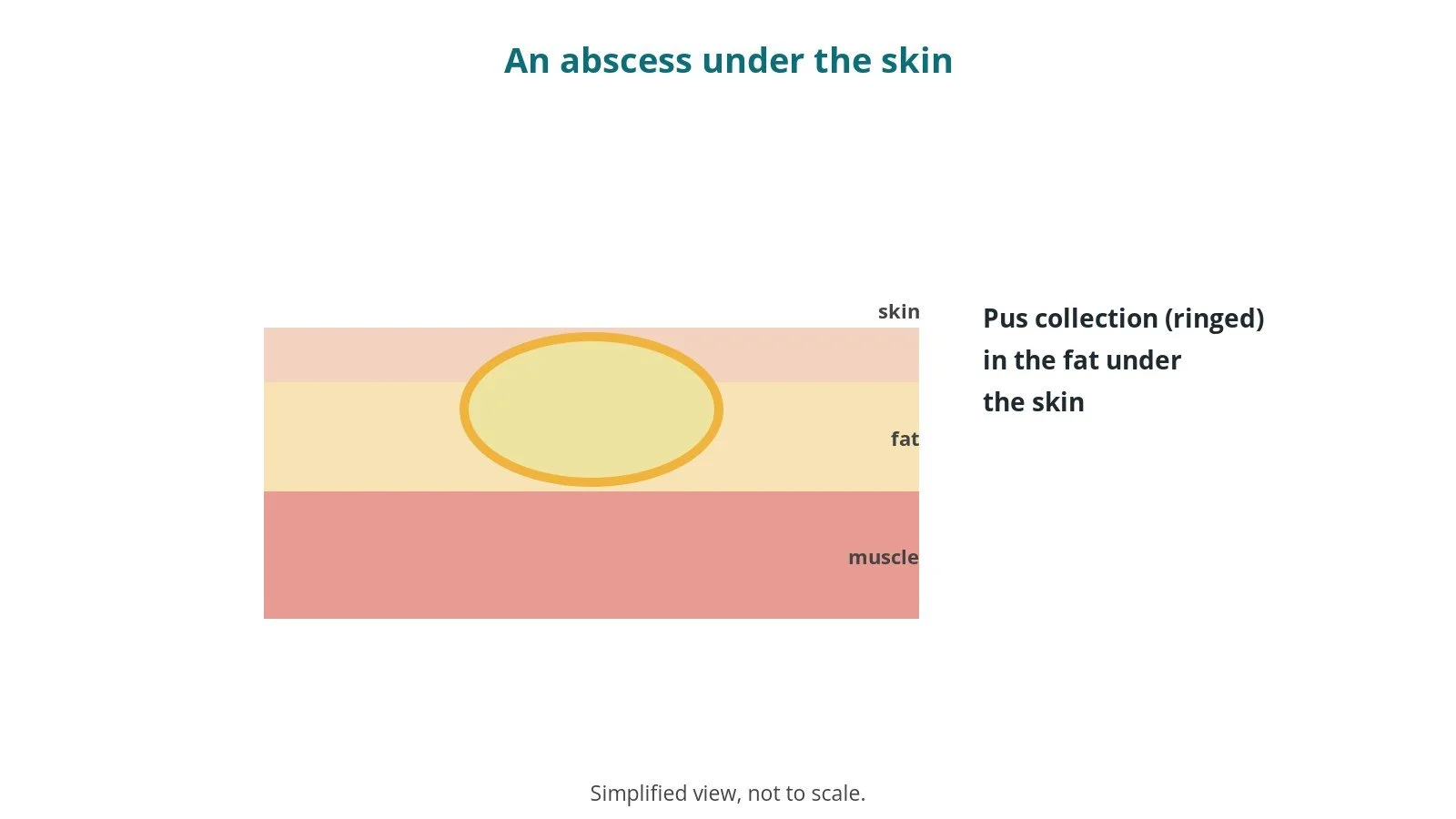 Cross-section diagram of skin, fat and muscle with a pus collection in the fat layer ringed