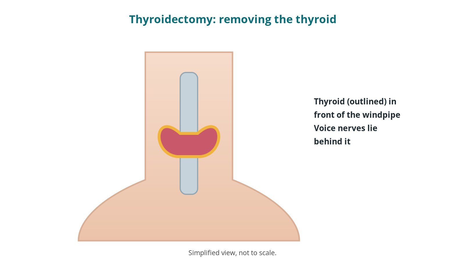 Diagram of the front of the neck showing the butterfly-shaped thyroid gland in front of the windpipe