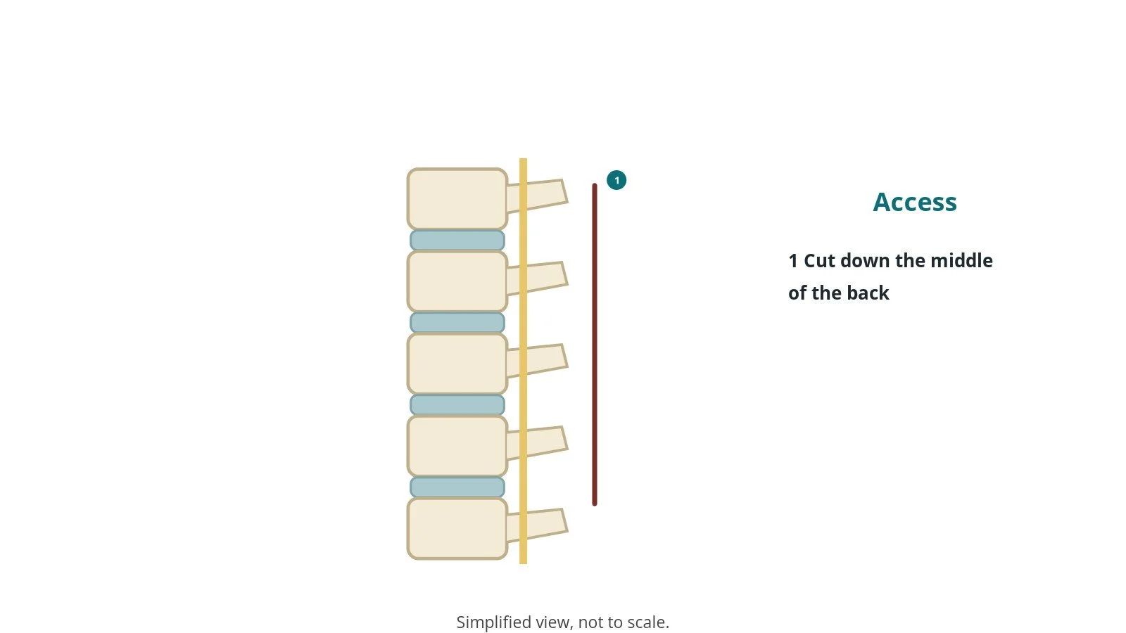 Side diagram of the lower spine showing an incision line along the back over the vertebrae
