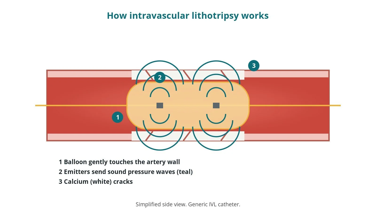 Side view of an IVL balloon inside a calcified artery, with emitters inside the balloon sending sound pressure waves outward that crack the calcium