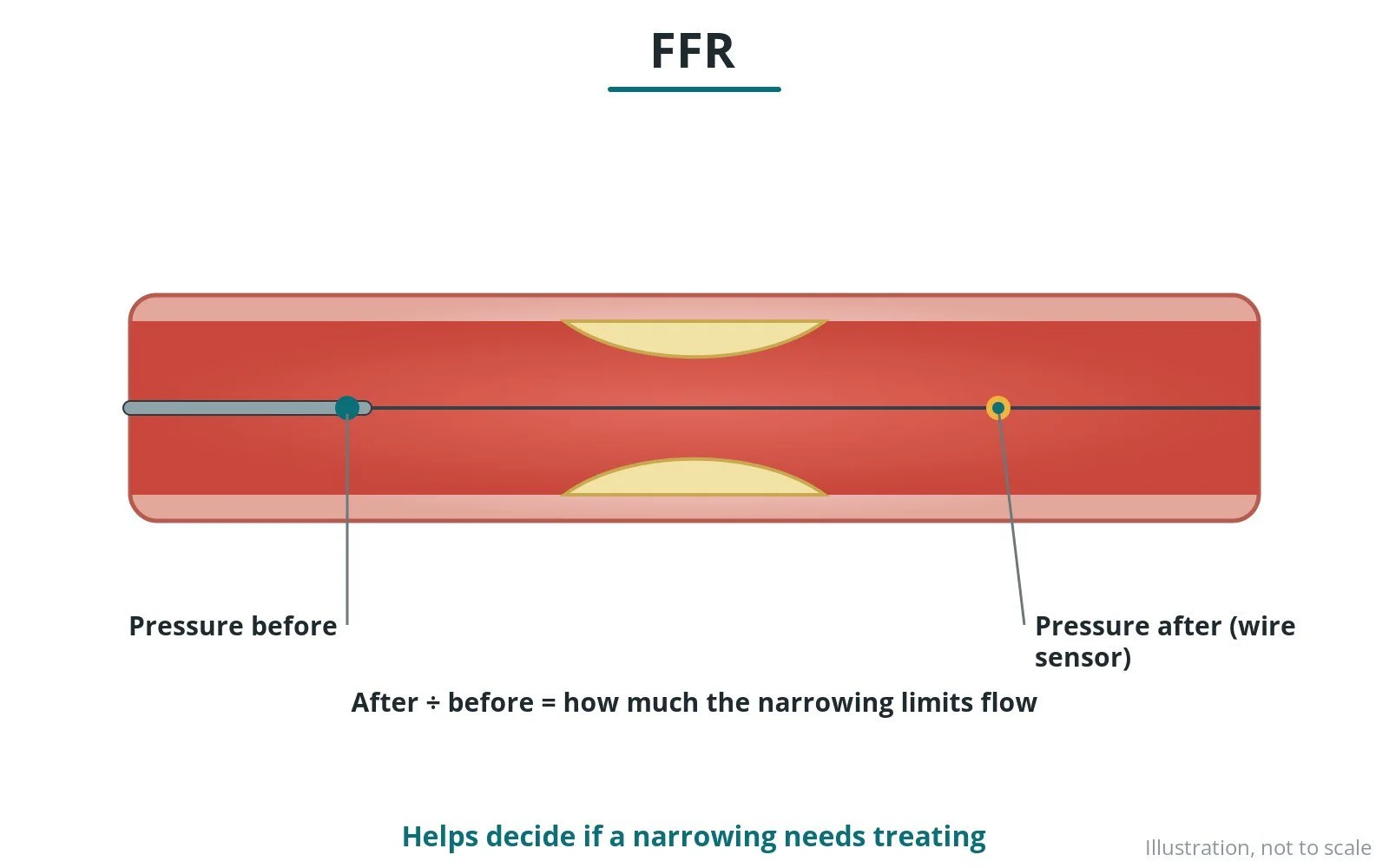 Diagram of a pressure wire beyond a narrowing comparing pressures