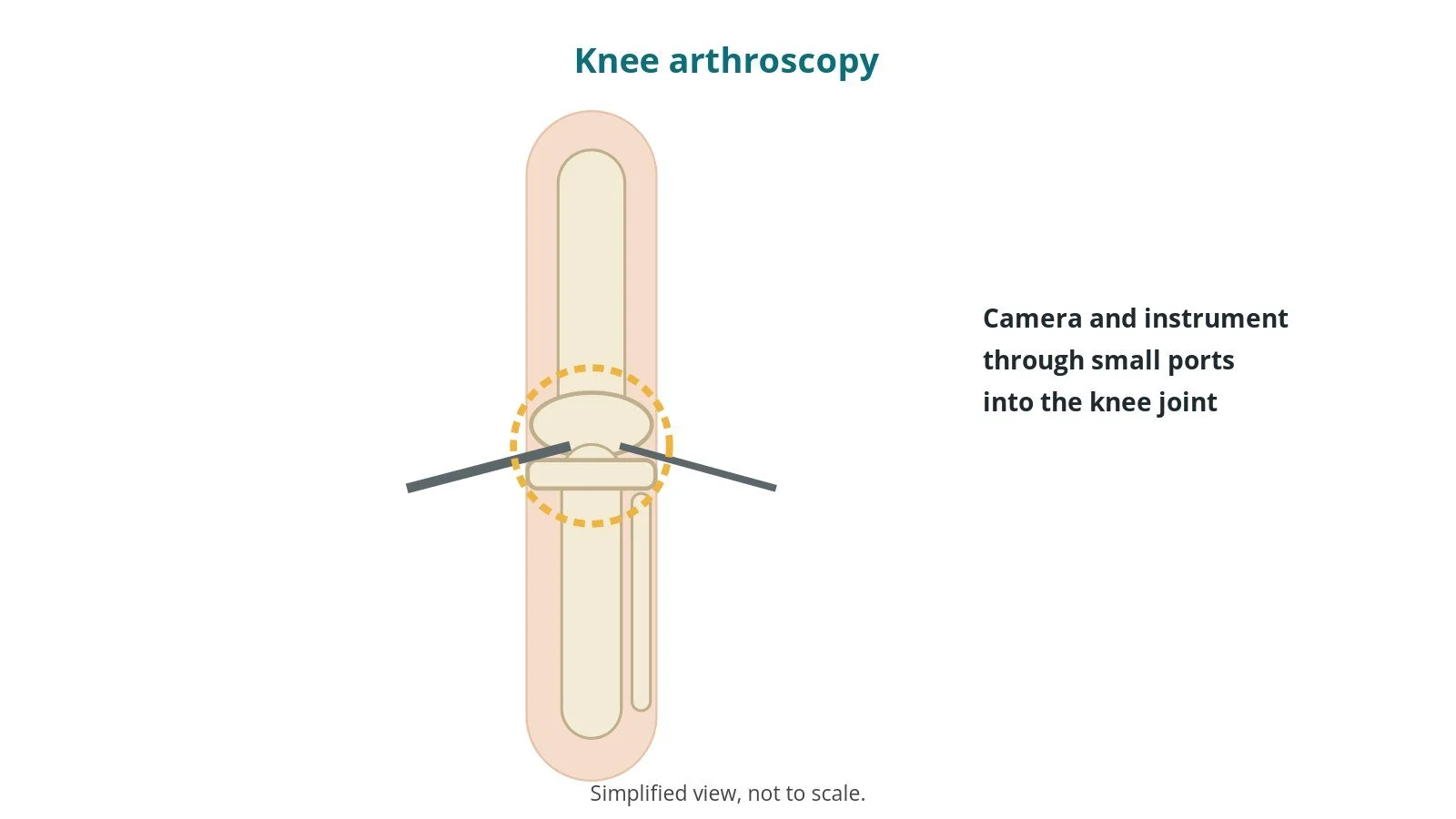 Diagram of a knee with a camera and an instrument entering the joint through small ports from each side